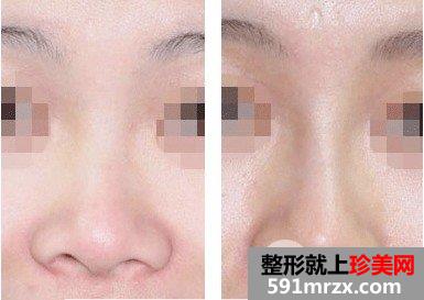 假体隆鼻整形术后可以戴眼镜吗，多久能恢复好