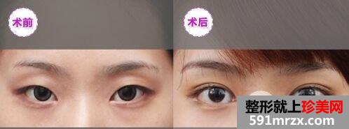 埋线双眼皮的线可以取出吗