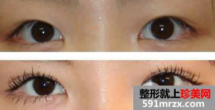 做开内眼角和外眼角手术有哪些区别