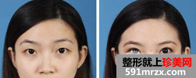 埋线和割双眼皮有什么不同、哪个效果好