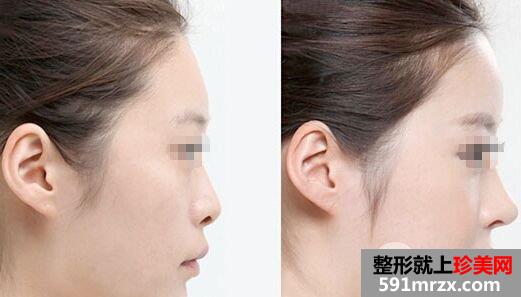 线雕隆鼻的效果如何、可以保持多少年
