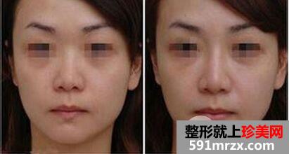 玻尿酸隆鼻和假体隆鼻哪个比较好、如何选择