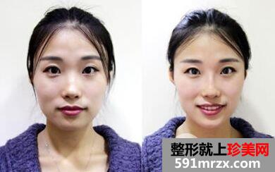 玻玻尿酸隆鼻后会变宽吗，为什么
