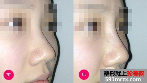 蛋白线隆鼻效果怎么样，可以保持几年，