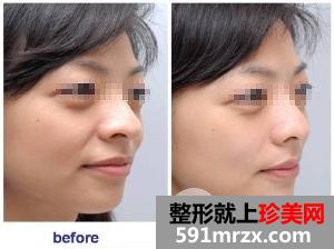 自体脂肪填充法令纹好吗、效果怎么样