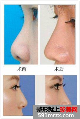 假体隆鼻之后可以再打玻尿酸吗