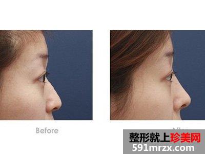 自体肋软骨隆鼻可以保持多久，有什么优势