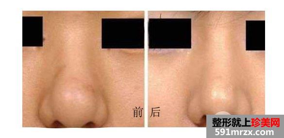 鼻头缩小手术效果怎么样、多久能恢复