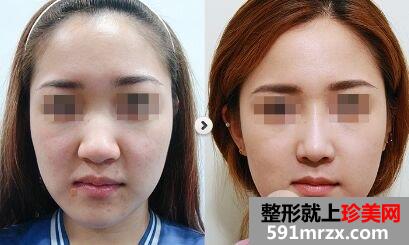 鼻翼过大如何变小、缩小鼻翼方法有哪些