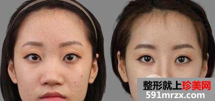 做鼻头缩小手术安全吗，有危险吗