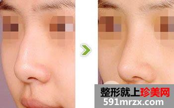 驼峰鼻矫正术后效果怎么样，自然吗