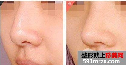 峰鼻矫正整形术后几天消肿，多久恢复