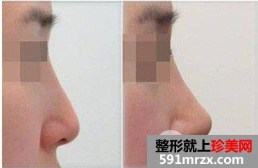 为什么注射隆鼻这么受欢迎，注射隆鼻效果好吗
