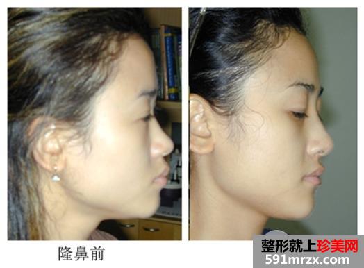 注射隆鼻后注意事项有哪些、如何护理