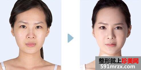 玻尿酸隆鼻需要注射几次才能达到永久的效果