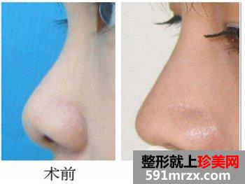 注射玻尿酸隆鼻后能看出痕迹吗
