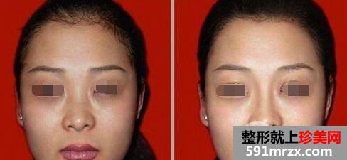 注射隆鼻疼吗、需要麻醉吗