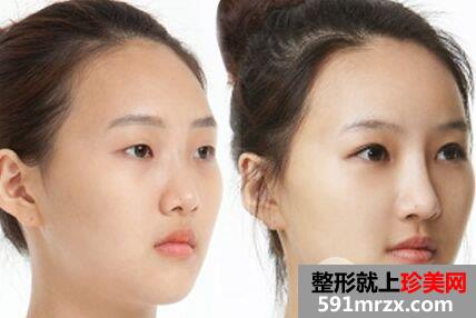 自体软骨隆鼻会产生副作用吗，有什么优点