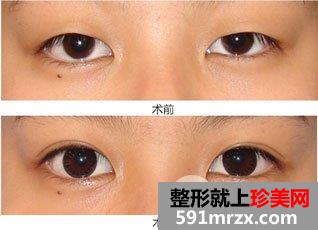 埋线双眼皮效果通常可以管多少年