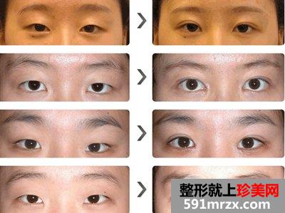 割双眼皮术后可以戴隐形眼镜吗