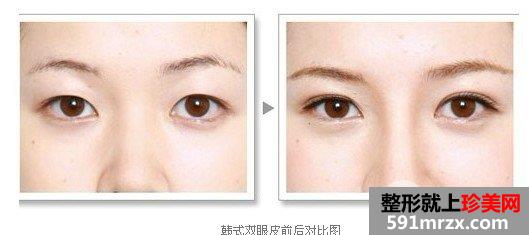 埋线双眼皮多久能恢复，可以保持几年