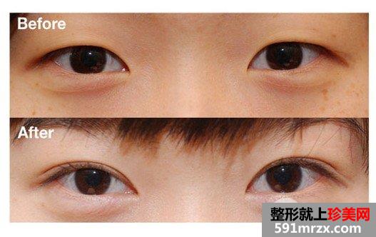 双眼皮整形术后多久可以运动，几天恢复好