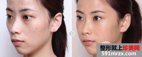 自体脂肪面部填充有什么用，会产生副作用吗