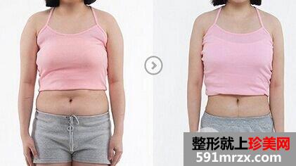 女性月经期间可以做吸脂减肥手术吗