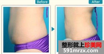 多大年龄可以做腰腹吸脂手术、效果到底怎么样