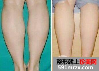 水动力吸脂瘦小腿效果如何、会反弹吗