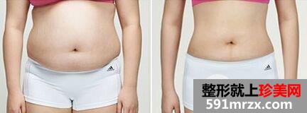 腰腹吸脂手术有哪些优点、好处是什么