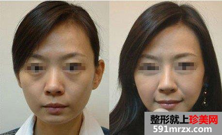 玻尿酸垫下巴后可以再做假体隆下巴吗