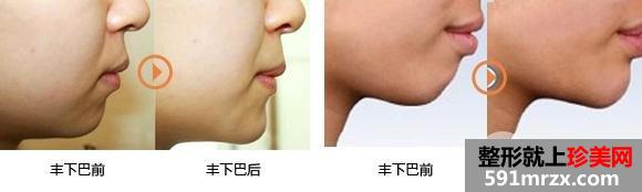 假体隆下巴用硅胶还是膨体比较好
