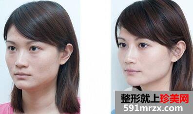 注射乔雅登隆鼻怎么样、有什么优势