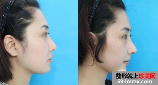 膨体隆鼻效果一般可以保持多长的时间
