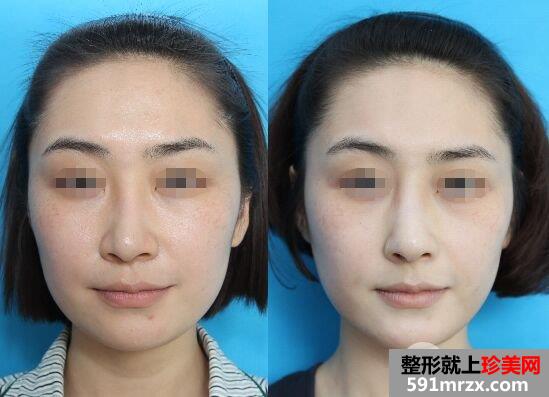 膨体隆鼻失败后取出需要多久恢复