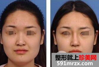 注射隆鼻安全性怎么样，会失败吗