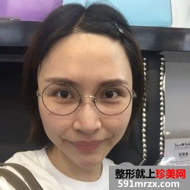 面部埋线提升后立现小V脸案例效果图分享