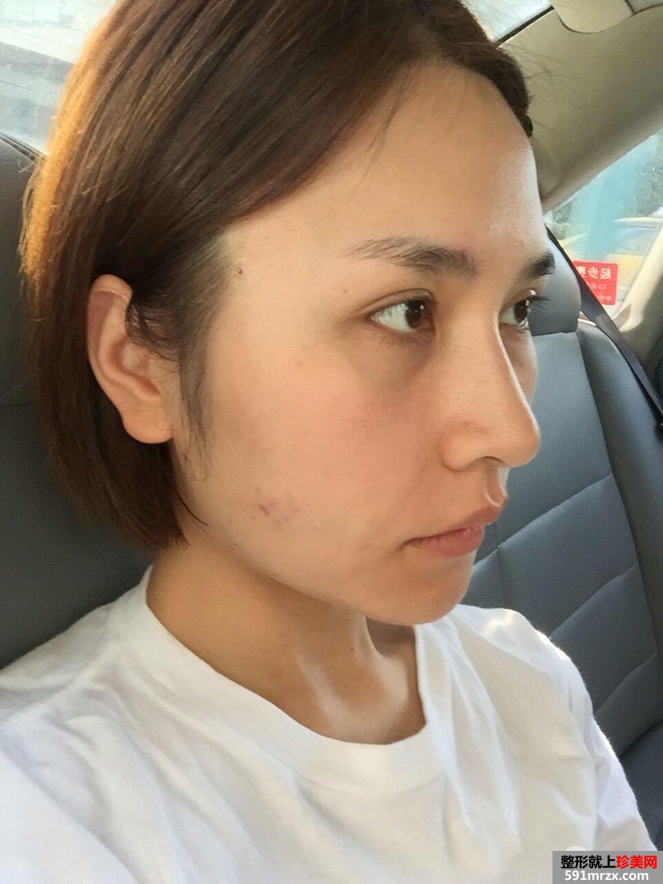 面部埋线提升后立现小V脸案例效果图分享