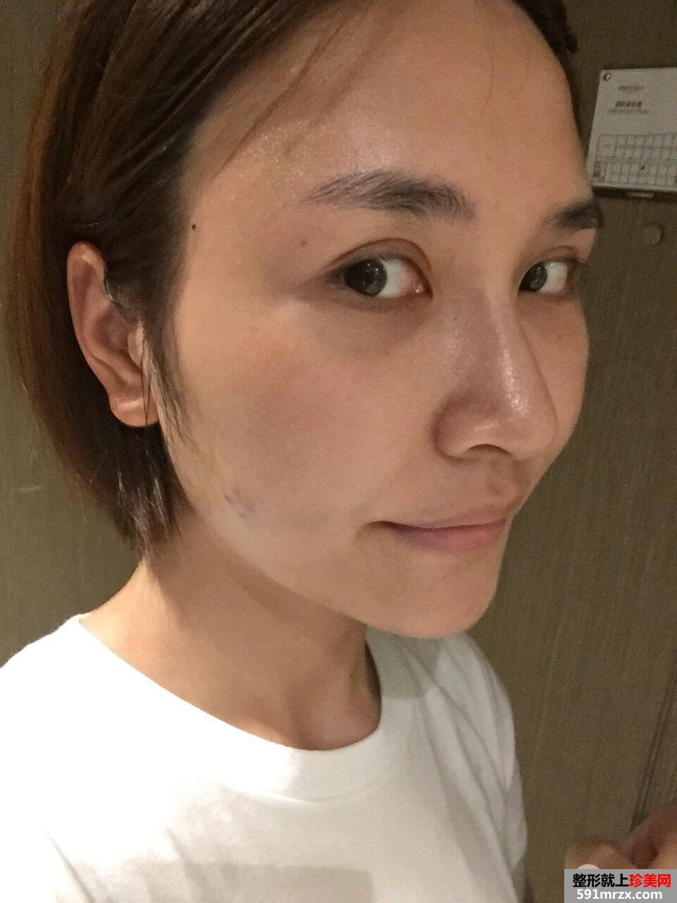 面部埋线提升后立现小V脸案例效果图分享