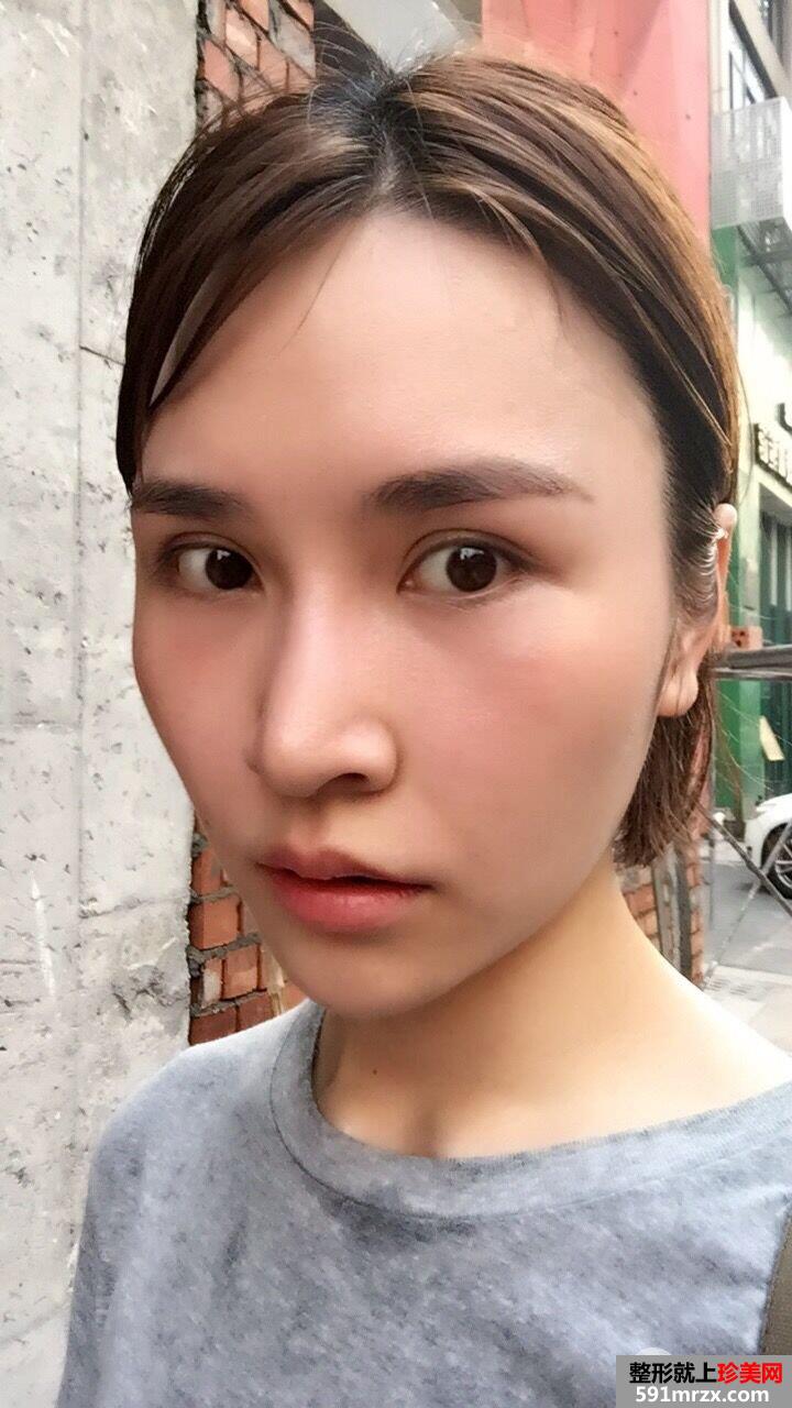 面部埋线提升后立现小V脸案例效果图分享