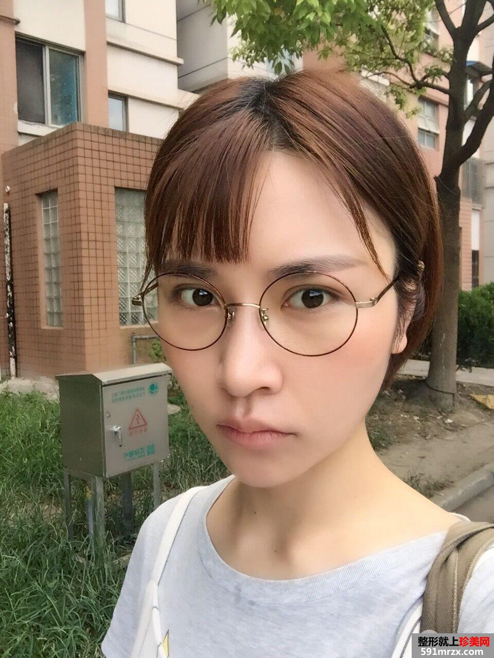 面部埋线提升后立现小V脸案例效果图分享