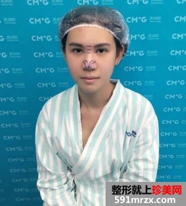 鼻综合整形打造混血小翘鼻手术过程真实案例分享