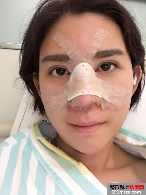 鼻综合整形打造混血小翘鼻手术过程真实案例分享