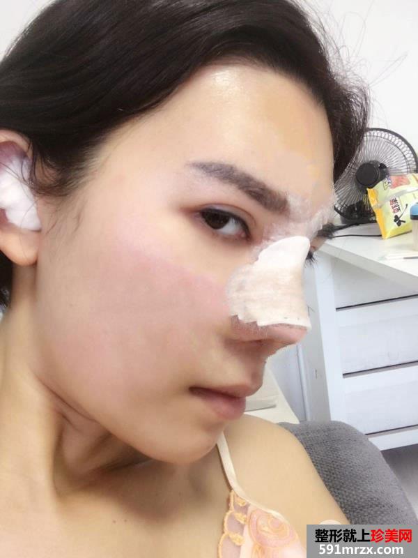 鼻综合整形打造混血小翘鼻手术过程真实案例分享