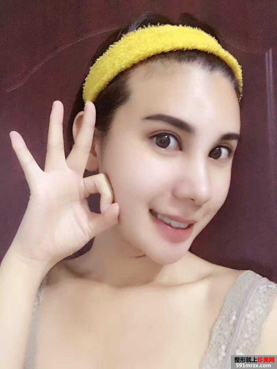 鼻综合整形打造混血小翘鼻手术过程真实案例分享