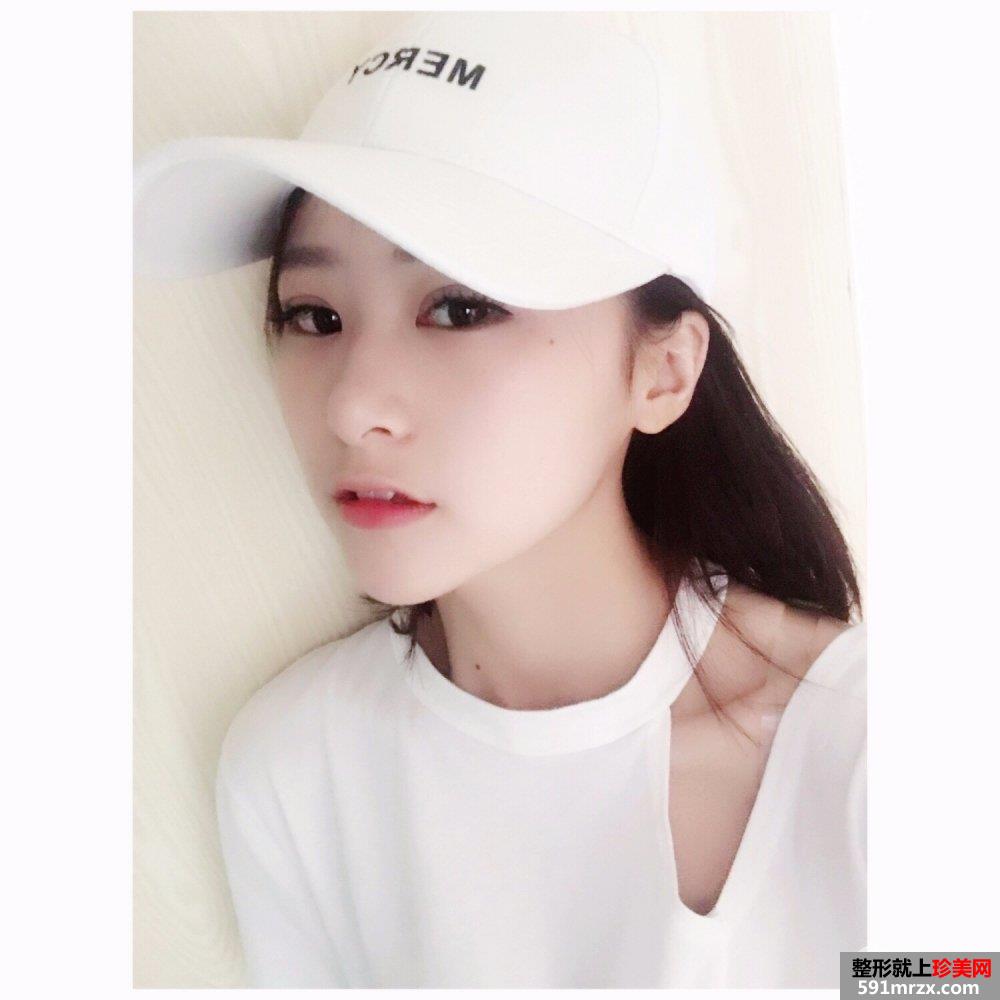 玻尿酸垫下巴+埋线双眼皮案例对比图 立现大眼睛小V脸