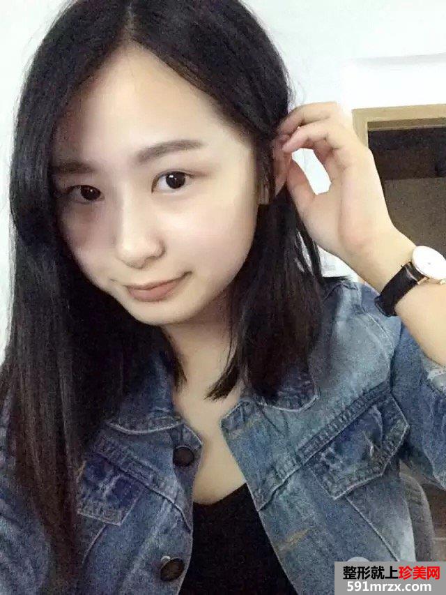 玻尿酸垫下巴+埋线双眼皮案例对比图 立现大眼睛小V脸