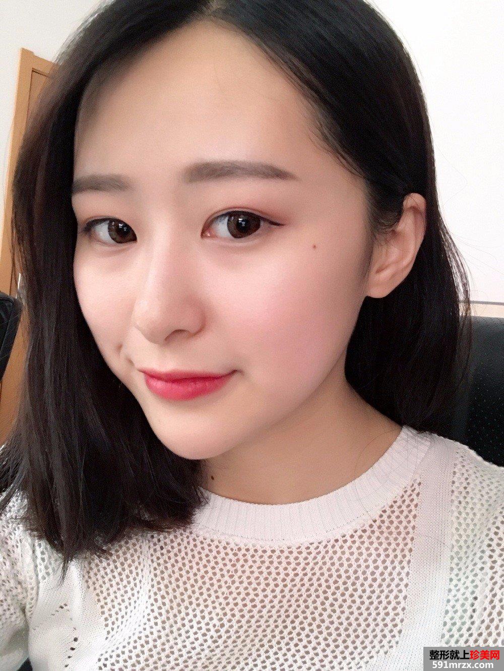 玻尿酸垫下巴+埋线双眼皮案例对比图 立现大眼睛小V脸