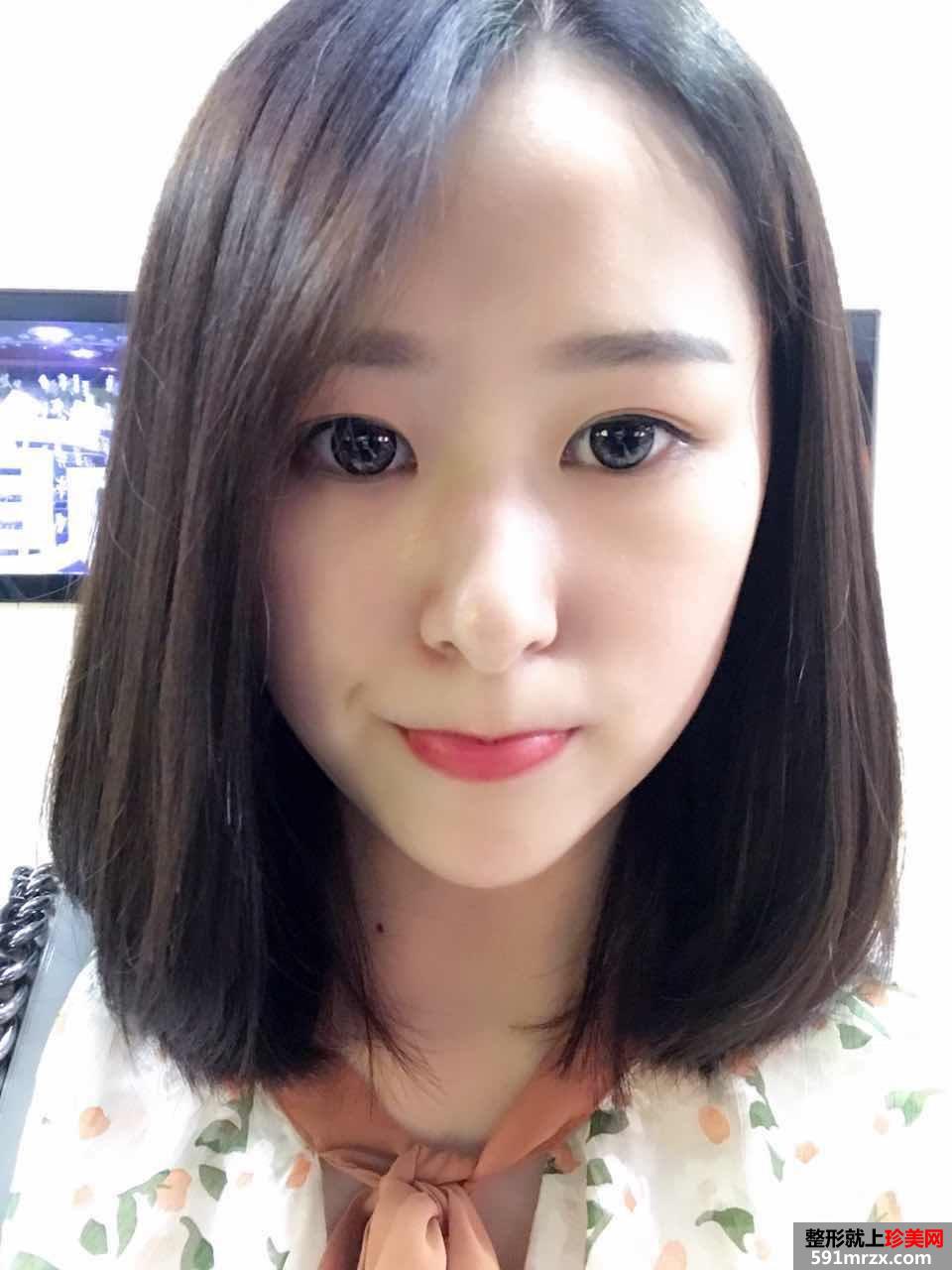 玻尿酸垫下巴+埋线双眼皮案例对比图 立现大眼睛小V脸